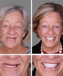 Fearaiy™ --Advanced Customized Full Denture Set