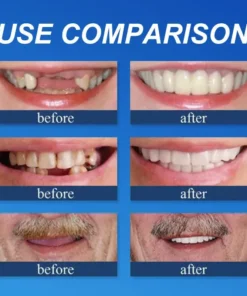 Fearaiy™ --Advanced Customized Full Denture Set