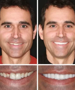 Fearaiy™ --Advanced Customized Full Denture Set