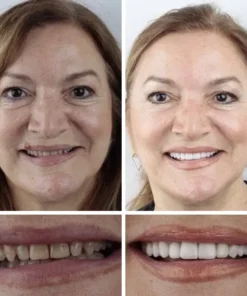 Fearaiy™ --Advanced Customized Full Denture Set