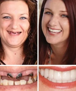 Fearaiy™ --Advanced Customized Full Denture Set